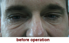 plastic-surgery-blepharoplasty